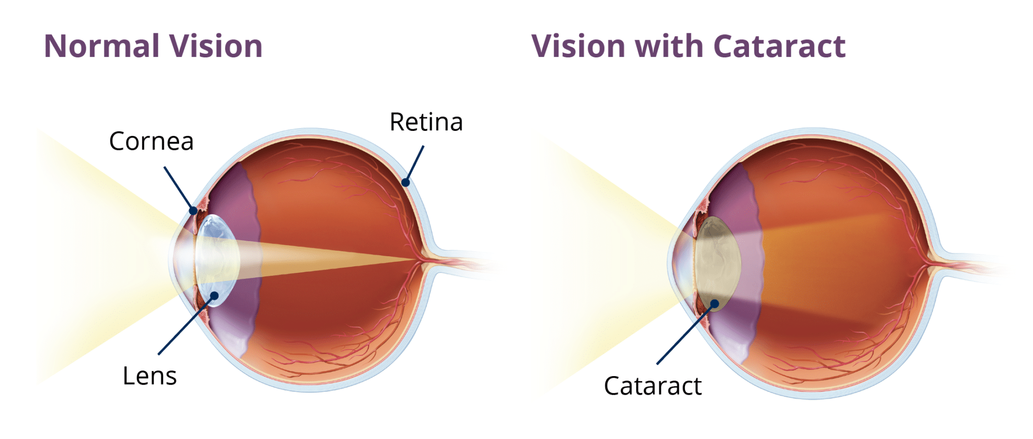 Cataract Anatomy