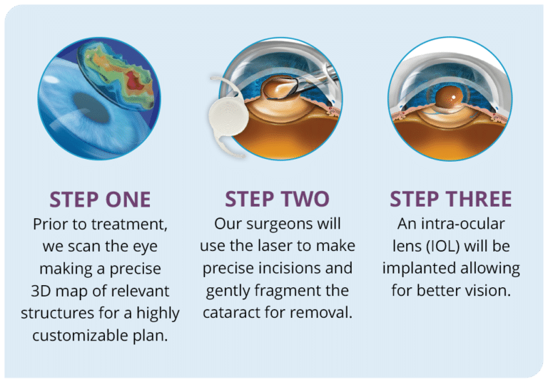 Cataract Treatments Ennen Eye Center